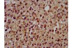 IHC image of CSB-PA007192LA01HU diluted at 1:200 and staining in paraffin-embedded human glioma cancer performed on a Leica BondTM system. After dewaxing and hydration, antigen retrieval was mediated by high pressure in a citrate buffer (pH 6.0). Section 