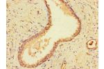 Immunohistochemistry of paraffin-embedded human prostate cancer using CSB-PA007211LA01HU at dilution of 1:100