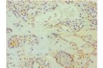 Immunohistochemistry of paraffin-embedded human breast cancer using CSB-PA007347ESR2HU at dilution 1:100