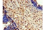 Immunohistochemistry of paraffin-embedded human ovarian cancer using CSB-PA007435LA01HU at dilution of 1:100