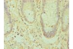 Immunohistochemistry of paraffin-embedded human rectal cancer using CSB-PA007460ESR1HU at dilution 1:100