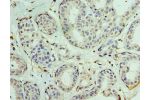 Immunohistochemistry of paraffin-embedded human breast cancer using CSB-PA007506DSR2HU at dilution 1:100