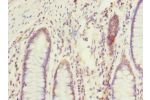 Immunohistochemistry of paraffin-embedded human colon cancer using CSB-PA007515ESR2HU at dilution 1:100