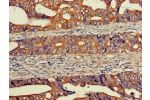 Immunohistochemistry of paraffin-embedded human colon cancer using CSB-PA007523LA01HU at dilution of 1:100