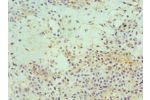 Immunohistochemistry of paraffin-embedded human breast cancer using CSB-PA007534ESR1HU at dilution 1:100