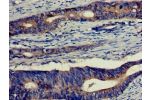 Immunohistochemistry of paraffin-embedded human colon cancer using CSB-PA007554LA01HU at dilution of 1:100
