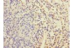 Immunohistochemistry of paraffin-embedded human bladder cancer using CSB-PA007558ESR1HU at dilution 1:100