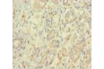 Immunohistochemistry of paraffin-embedded human pancreatic cancer using CSB-PA007572HA01HU at dilution 1:100