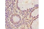 Immunohistochemistry of paraffin-embedded human colon cancer using CSB-PA007582LA01HU at dilution 1:100