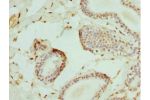 Immunohistochemistry of paraffin-embedded human breast cancer using CSB-PA007596DSR2HU at dilution 1:100
