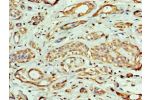 Immunohistochemistry of paraffin-embedded human breast cancer using CSB-PA007666ESR2HU at dilution 1:100