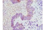 Immunohistochemistry of paraffin-embedded human ovarian cancer using CSB-PA007677ESR1HU at dilution 1:100