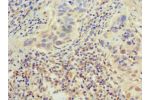 Immunohistochemistry of paraffin-embedded CSB-PA007702HA01HU using human bladder cancer at dilution 1:100