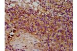 IHC image of CSB-PA007756LA01HU diluted at 1:300 and staining in paraffin-embedded human ovarian cancer performed on a Leica BondTM system. After dewaxing and hydration, antigen retrieval was mediated by high pressure in a citrate buffer (pH 6.0). Section