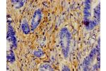 Immunohistochemistry of paraffin-embedded human rectal cancer using CSB-PA007759LA01HU at dilution of 1:100