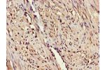 Immunohistochemistry of paraffin-embedded human endometrial cancer using CSB-PA007760LA01HU at dilution of 1:100