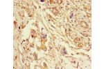 Immunohistochemistry of paraffin-embedded human pancreatic cancer using CSB-PA007791LA01HU at dilution of 1:100