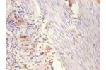 Immunohistochemistry of paraffin-embedded human breast cancer using CSB-PA007830YA01HU at dilution 1:100