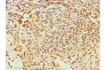 Immunohistochemistry of paraffin-embedded human breast cancer using CSB-PA007834DSR2HU at dilution 1:100