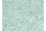 Immunohistochemistry of paraffin-embedded human breast cancer using CSB-PA007860ESR1HU at dilution 1:100