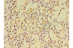 Immunohistochemistry of paraffin-embedded human breast cancer using CSB-PA007878ESR1HU at dilution 1:100