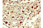 IHC image of CSB-PA007889LA01HU diluted at 1:300 and staining in paraffin-embedded human melanoma cancer performed on a Leica BondTM system. After dewaxing and hydration, antigen retrieval was mediated by high pressure in a citrate buffer (pH 6.0). Sectio