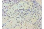 Immunohistochemistry of paraffin-embedded human breast cancer tissue using CSB-PA007907LA01HU at dilution 1:100