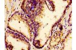 Immunohistochemistry of paraffin-embedded human prostate cancer using CSB-PA007918LA01HU at dilution of 1:100