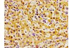 Immunohistochemistry of paraffin-embedded human liver cancer using CSB-PA007919LA01HU at dilution of 1:100