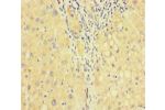 Immunohistochemistry of paraffin-embedded human liver cancer using CSB-PA007929HA01HU at dilution of 1:100