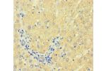 Immunohistochemistry of paraffin-embedded human liver cancer using CSB-PA007930HA01HU at dilution of 1:100