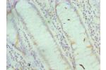 Immunohistochemistry of paraffin-embedded human rectal cancer using CSB-PA007955ESR1HU at dilution 1:100