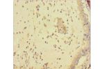 Immunohistochemistry of paraffin-embedded human lung cancer using CSB-PA007987LA01HU at dilution 1:100