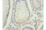 Immunohistochemistry of paraffin-embedded human colon cancer using CSB-PA008227LA01HU at dilution of 1:100