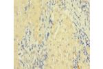 Immunohistochemistry of paraffin-embedded human liver cancer using CSB-PA008434LA01HU at dilution 1:100