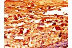 Immunohistochemistry of paraffin-embedded human melanoma cancer using CSB-PA008456LA01HU at dilution of 1:100