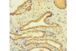 Immunohistochemistry of paraffin-embedded human prostate cancer using CSB-PA008532LA01HU at dilution of 1:100