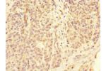 Immunohistochemistry of paraffin-embedded human ovarian cancer using CSB-PA008542ESR1HU at dilution 1:100