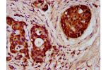 IHC image of CSB-PA008546LA01HU diluted at 1:300 and staining in paraffin-embedded human pancreatic cancer performed on a Leica BondTM system. After dewaxing and hydration, antigen retrieval was mediated by high pressure in a citrate buffer (pH 6.0). Sect