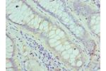 Immunohistochemistry of paraffin-embedded human colon cancer using CSB-PA008615ESR2HU at dilution 1:100