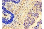 Immunohistochemistry of paraffin-embedded human ovarian cancer using CSB-PA008637LA01HU at dilution of 1:100