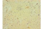 Immunohistochemistry of paraffin-embedded human glioma using CSB-PA008638ESR1HU at dilution 1:100