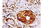 Immunohistochemistry of paraffin-embedded human breast cancer using CSB-PA008724LA01HU at dilution of 1:100