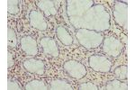 Immunohistochemistry of paraffin-embedded human colon cancer using CSB-PA008746ESR2HU at dilution 1:100