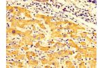 IHC image of CSB-PA008749LA01HU diluted at 1:300 and staining in paraffin-embedded human liver cancer performed on a Leica BondTM system. After dewaxing and hydration, antigen retrieval was mediated by high pressure in a citrate buffer (pH 6.0). Section w
