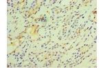 Immunohistochemistry of paraffin-embedded human breast cancer using CSB-PA008793ESR1HU at dilution 1:100