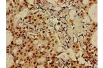 Immunohistochemistry of paraffin-embedded human breast cancer using CSB-PA008794LA01HU at dilution of 1:100