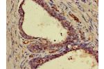 Immunohistochemistry of paraffin-embedded human prostate cancer using CSB-PA009004LA01HU at dilution of 1:100