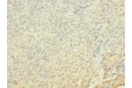 Immunohistochemistry of paraffin-embedded human cervical cancer CSB-PA009005LA01HU at dilution 1:100