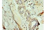 Immunohistochemistry of paraffin-embedded human breast cancer using CSB-PA009080ESR1HU at dilution 1:100